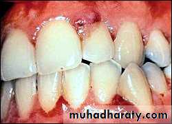 classification of periodontal disease