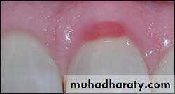 classification of periodontal disease