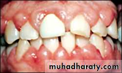 classification of periodontal disease