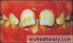classification of periodontal disease