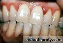 classification of periodontal disease
