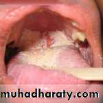 classification of periodontal disease