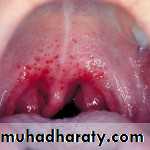 classification of periodontal disease