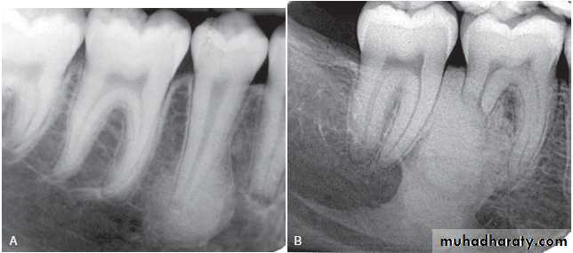 Inflametary lesions of the jaw