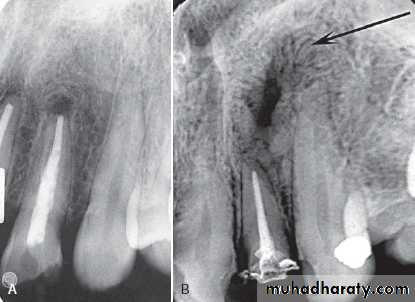 Inflametary lesions of the jaw