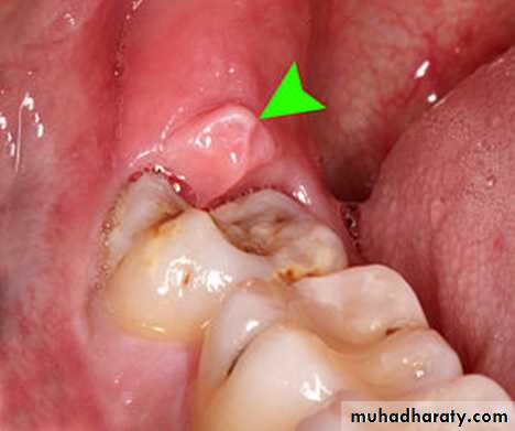 Inflametary lesions of the jaw