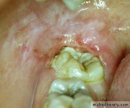 Inflametary lesions of the jaw