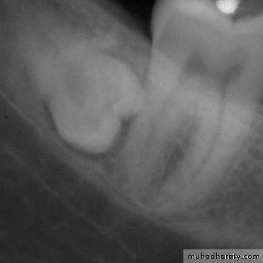 Inflametary lesions of the jaw