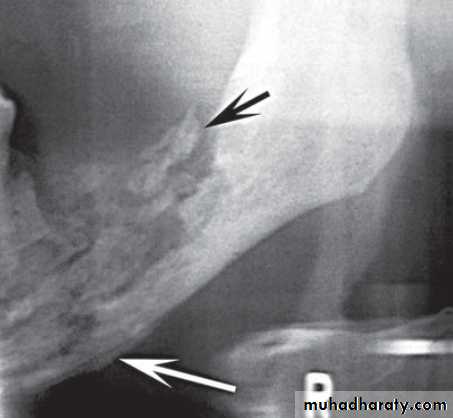 Inflametary lesions of the jaw