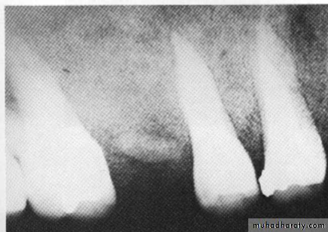 Inflametary lesions of the jaw
