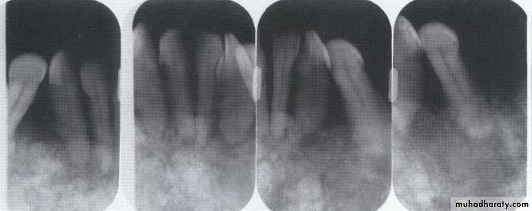 Inflametary lesions of the jaw