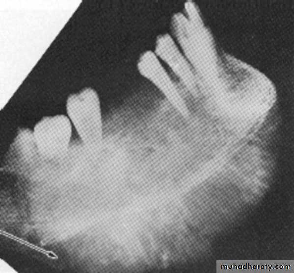 Inflametary lesions of the jaw