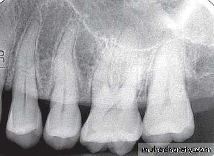 Inflametary lesions of the jaw