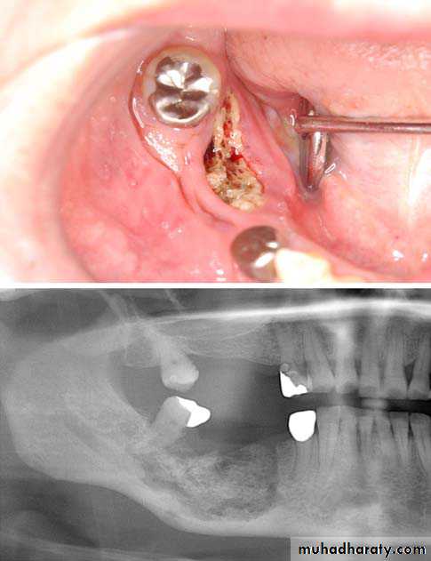 Inflametary lesions of the jaw