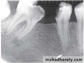 Inflametary lesions of the jaw