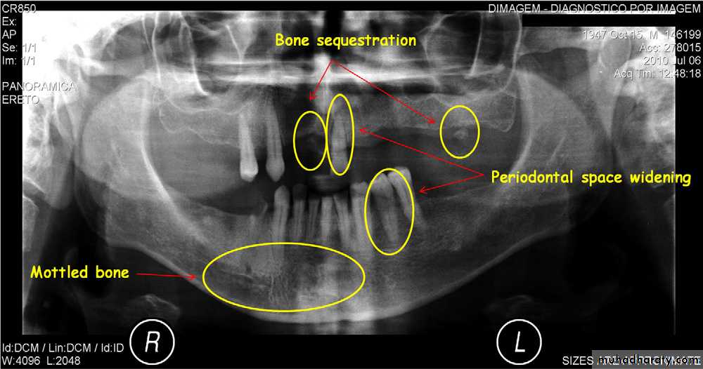 Inflametary lesions of the jaw