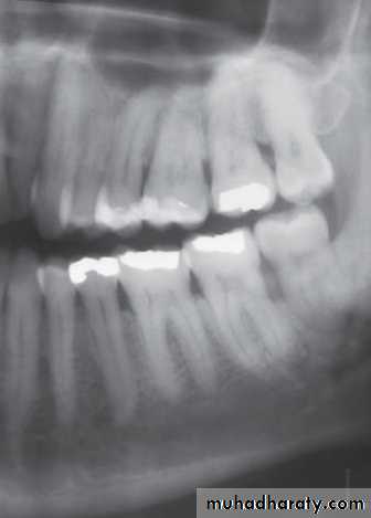 Inflametary lesions of the jaw