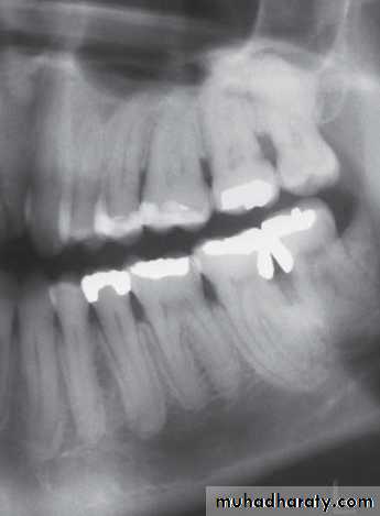 Inflametary lesions of the jaw
