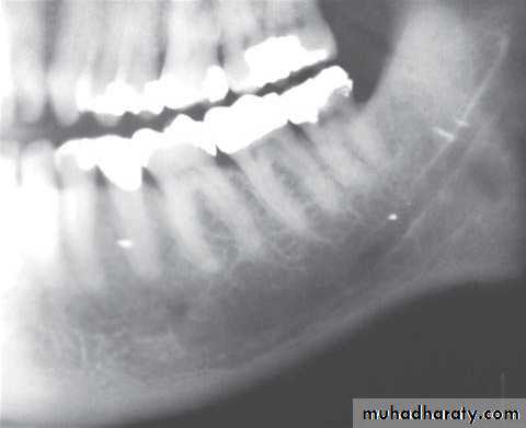 Inflametary lesions of the jaw