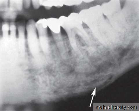 Inflametary lesions of the jaw