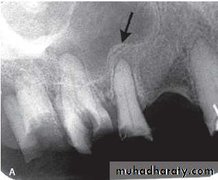 Inflametary lesions of the jaw