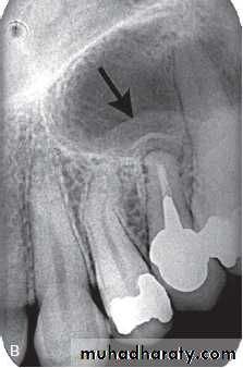 Inflametary lesions of the jaw