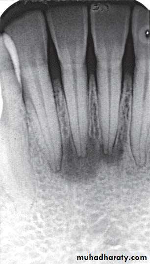Inflametary lesions of the jaw