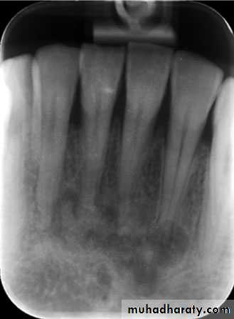 Inflametary lesions of the jaw