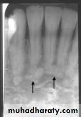 Inflametary lesions of the jaw