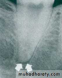 endo