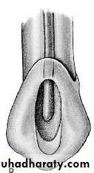 endo