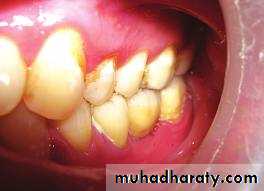 diagnosis and treatment plane for RPD-part 2