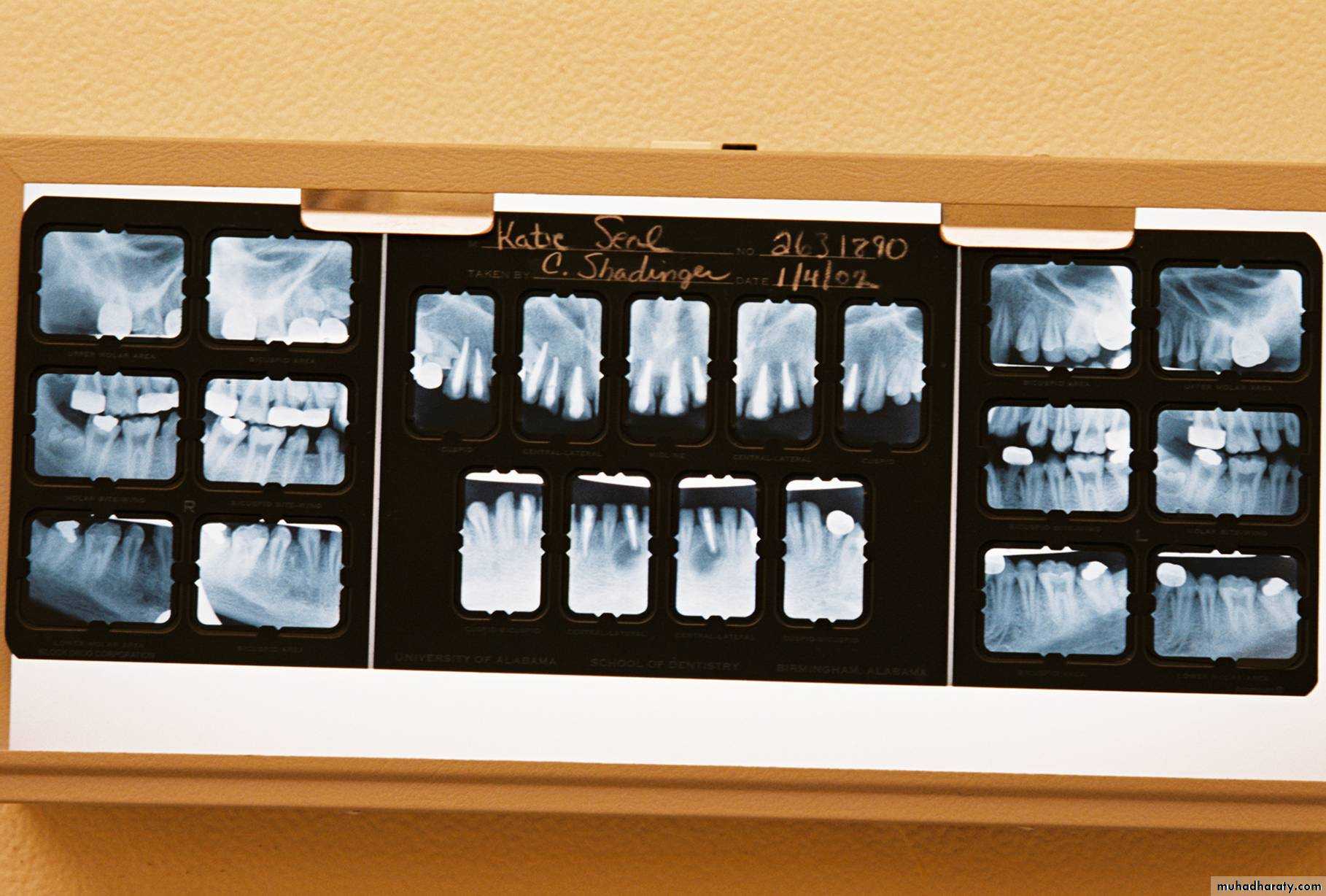 diagnosis and treatment plane for RPD-part 2