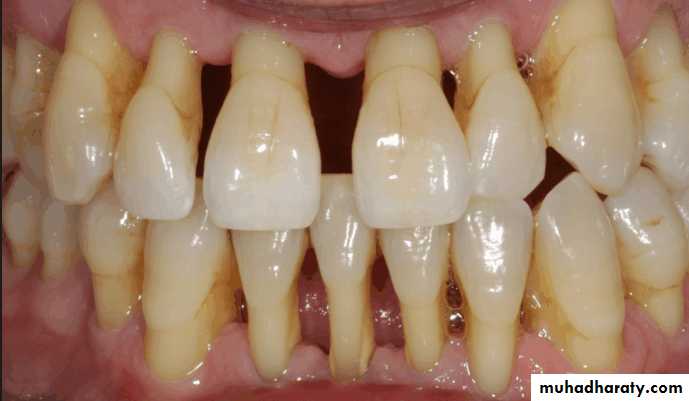 diagnosis and treatment plane for RPD-part 2