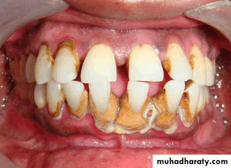 diagnosis and treatment plane for RPD-part 2