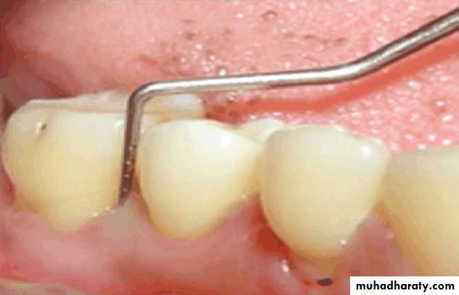diagnosis and treatment plane for RPD-part 2