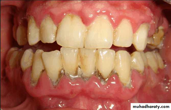 diagnosis and treatment plane for RPD-part 2