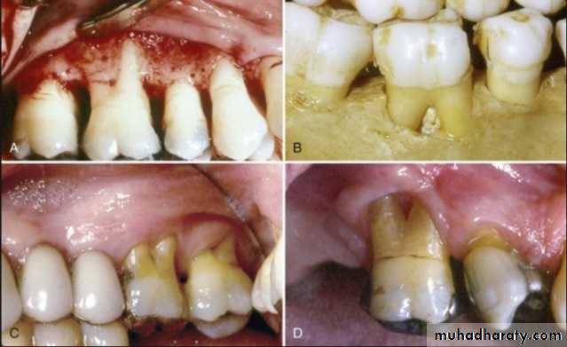 diagnosis and treatment plane for RPD-part 2