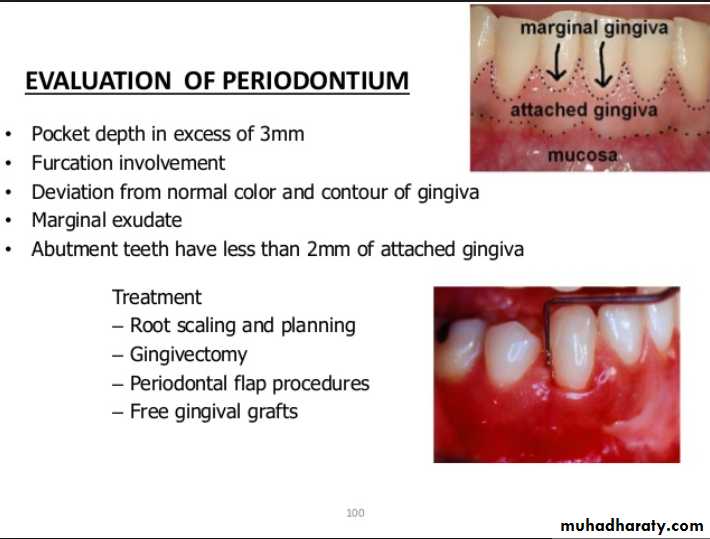 diagnosis and treatment plane for RPD-part 2