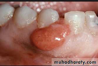 diagnosis and treatment plane for RPD-part 2