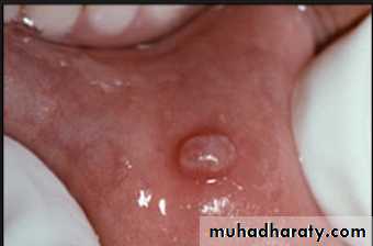 diagnosis and treatment plane for RPD-part 2