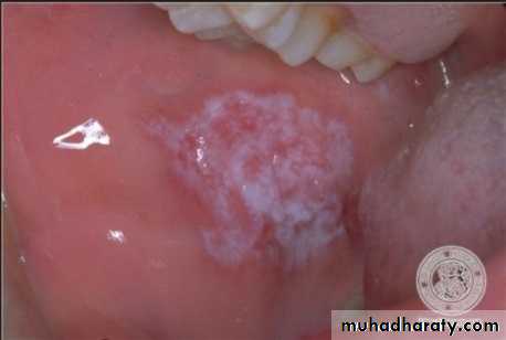 diagnosis and treatment plane for RPD-part 2