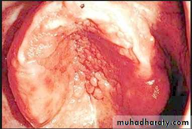 diagnosis and treatment plane for RPD-part 2