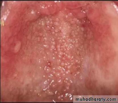 diagnosis and treatment plane for RPD-part 2