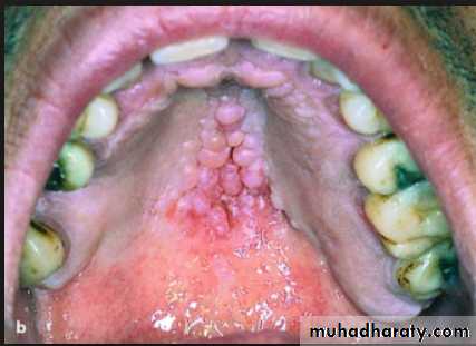 diagnosis and treatment plane for RPD-part 2