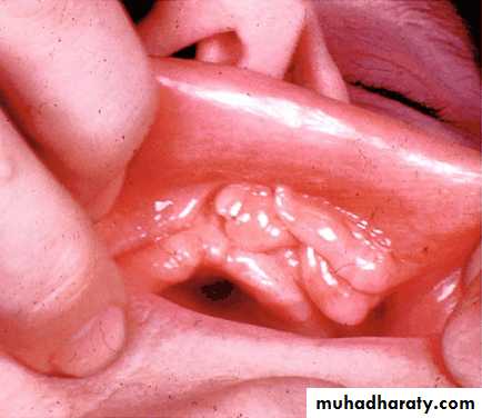 diagnosis and treatment plane for RPD-part 2