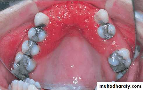 diagnosis and treatment plane for RPD-part 2