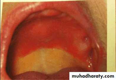 diagnosis and treatment plane for RPD-part 2