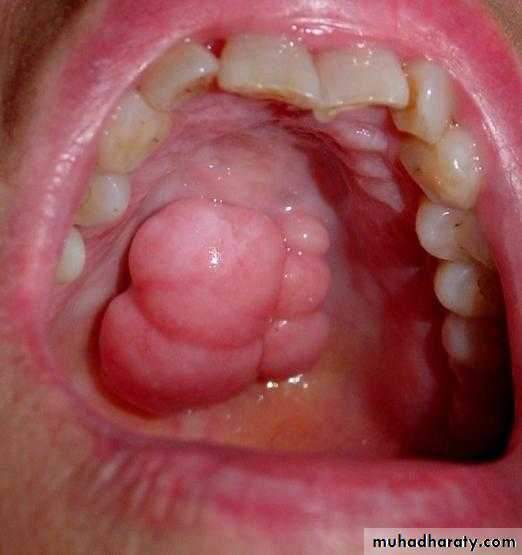 diagnosis and treatment plane for RPD-part 2