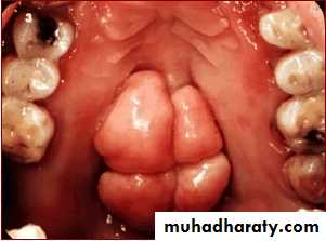 diagnosis and treatment plane for RPD-part 2